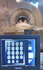 Εγκεφαλικοί όγκοι, μηνιγγείωμα: Για την παρακολούθηση των ασθενών μετά από τις θεραπείες, απαιτούνται απεικονιστικοί έλεγχοι με μαγνητική τομογραφία για όλη τη ζωή του ασθενούς.