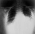 Ακτινογραφία θώρακα ασθενούς με άνθρακα των πνευμόνων και του αναπνευστικού συστήματος.