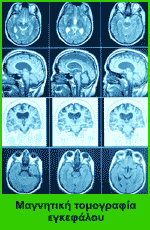 Το γλοίωμα εγκεφάλου σταδίου IV, είναι από τις πλέον επιθετικές μορφές καρκίνου. Η μαγνητική τομογραφία βοηθά τα μέγιστα στη διάγνωση.