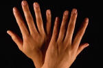 Τα χέρια προσβάλλονται συχνά από τις αρθρίτιδες