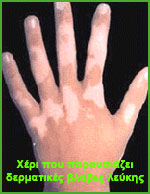 Χέρι που παρουσιάζει δερματικές βλάβες λεύκης
