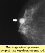 Μαστογραφία στην οποία ανιχνεύτηκε καρκίνος του μαστού.