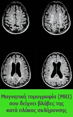 Μαγνητική τομογραφία (MRI) που δείχνει βλάβες της κατά πλάκας σκλήρυνσης.