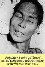 Ασθενής 46 ετών με τέτανο και μυϊκούς σπασμούς σε πολλά μέρη του σώματος, 1965.