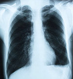 Η ακτινογραφία θώρακος βοηθά στη διάγνωση του άσθματος.