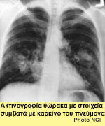 Ακτινογραφία θώρακα με στοιχεία συμβατά με καρκίνο του πνεύμονα. Photo NCI